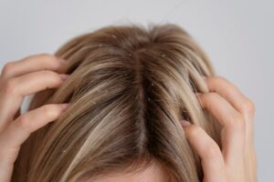Mulher com as mãos na cabeça, onde o tema representado é 1. Caspa: Causas e Soluções Caseiras Eficazes