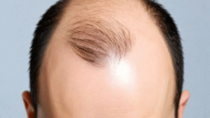 Homem mostrando a cabela com pouco de cabelo