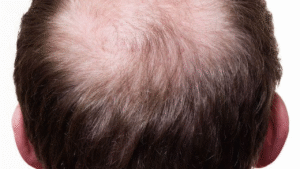 Imagem mostra um homem com pouca cabelo 